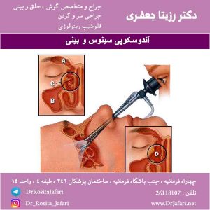 آندوسکوپی-سینوس-و-بینی