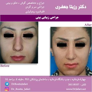 جراحی بینی 2