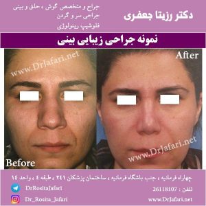 عکس عمل بینی