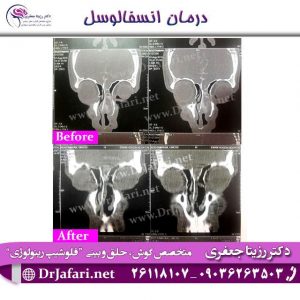 درمان انسفالوسل