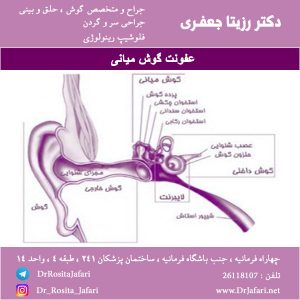 عفونت گوش میانی