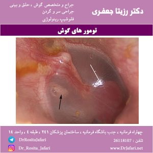 تومورهای گوش