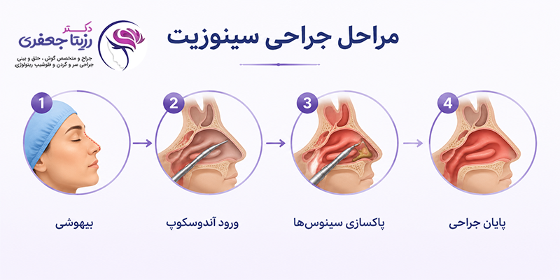 مراحل جراحی سینوزیت