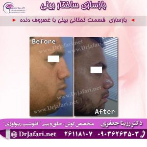 بازسازی ساختار بینی
