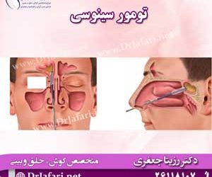 تومور سینوسی