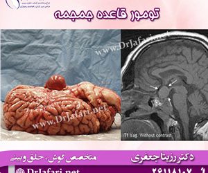 تومور قاعده جمجمه