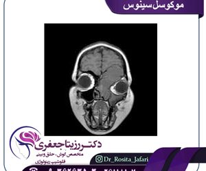 موکوسل سینوس