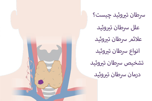 سرطان تیروئید چیست؟