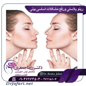 رینو پلاستی ورفع مشکلات اساسی بینی