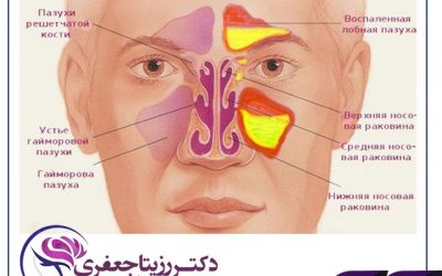 سینوزیت ماگزیلاری با منشاء اودنتوژنیک