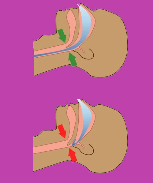 آپنه-انسدادی-خواب