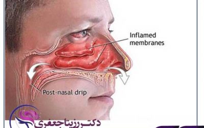 کاهش حس بویایی و بیماری کرونا