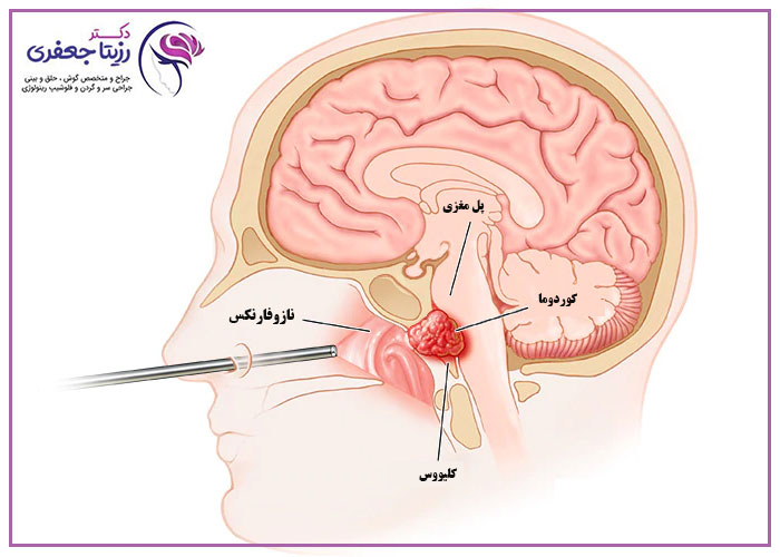 تومور-کوردوما