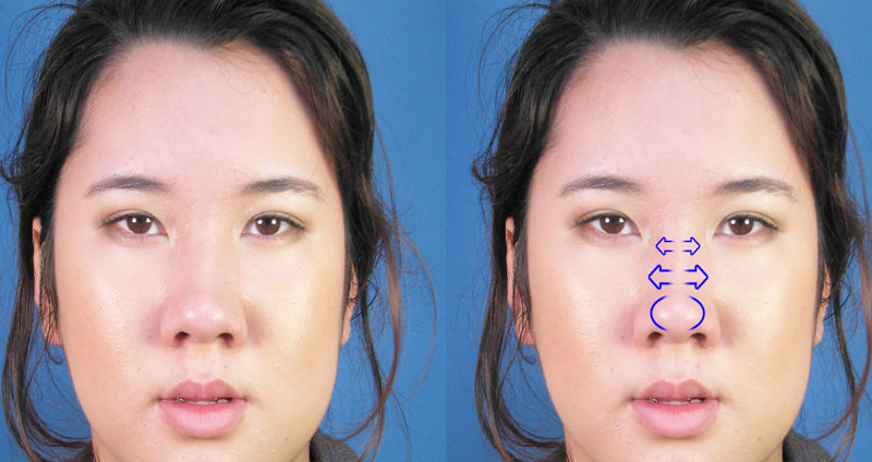 رینوپلاستی-شرقی