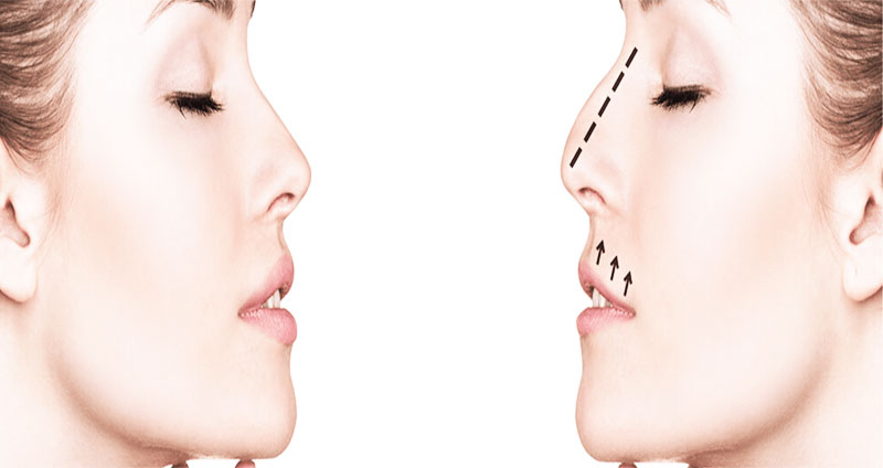 رینوپلاستی-غربی