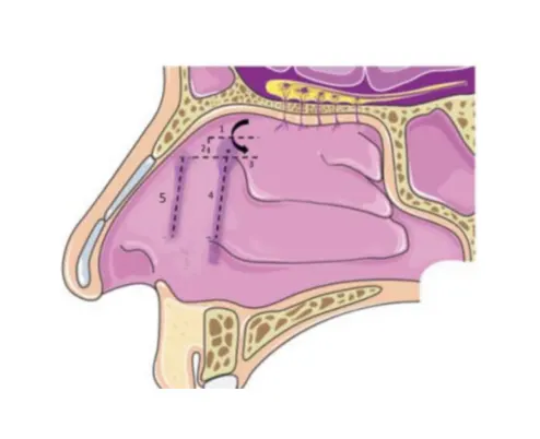 جراحی-با-روش-آندوسکوپی