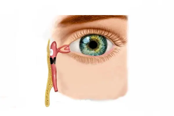 داکریوسیستورینوستومی