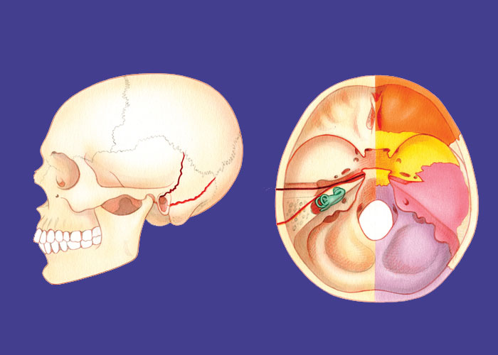 انواع-شکستگی-قاعده-جمجمه