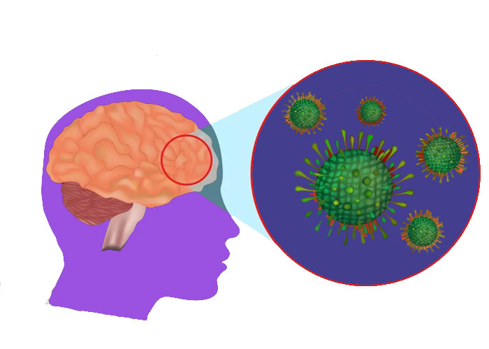 شناخت-انواع-مننژیت