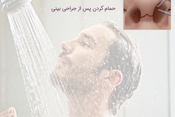 حمام کردن پس از عمل بینی