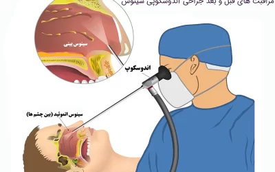 مراقبت های جراحی آندوسکوپی سینوس