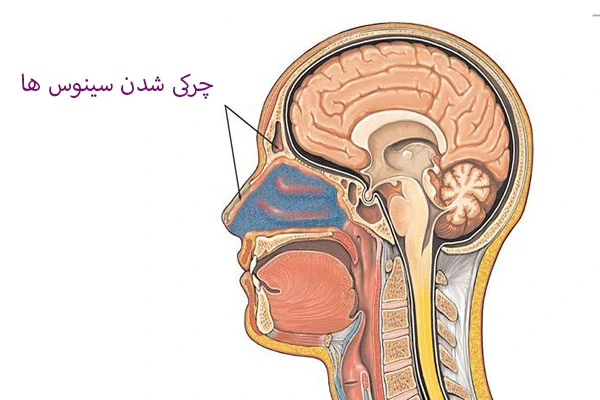 چرکی شدن سینوس ها