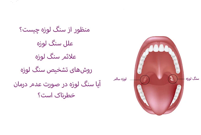 سنگ لوزه چیست؟