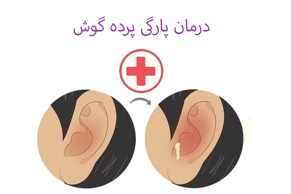 درمان پارگی پرده گوش