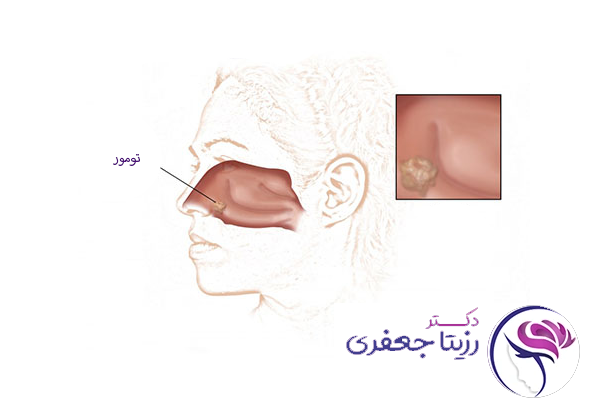 تومورهای بینی و سینوس