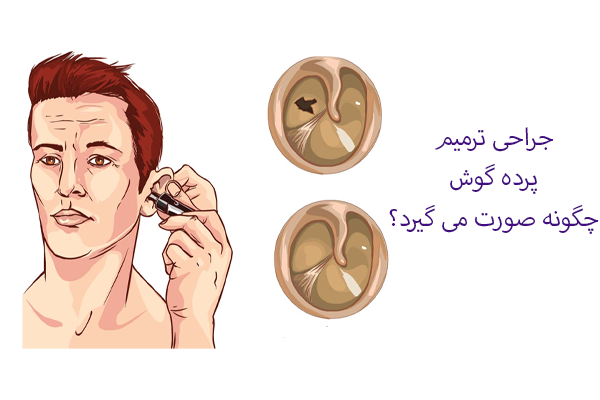 جراحی ترمیم پرده گوش
