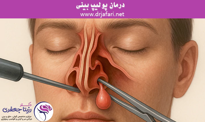 درمان پولیپ بینی