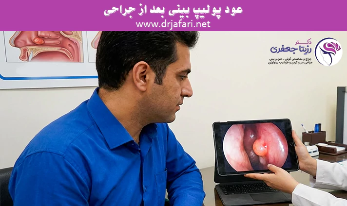 عود پولیپ بینی بعد از جراحی