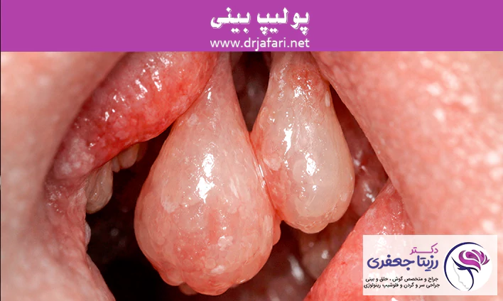 پولیپ بینی چیست؟